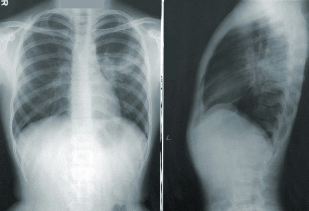 HUAP em foco: Inteligência artificial e ciência de dados ajudam no diagnóstico de doenças pulmonares - UFF